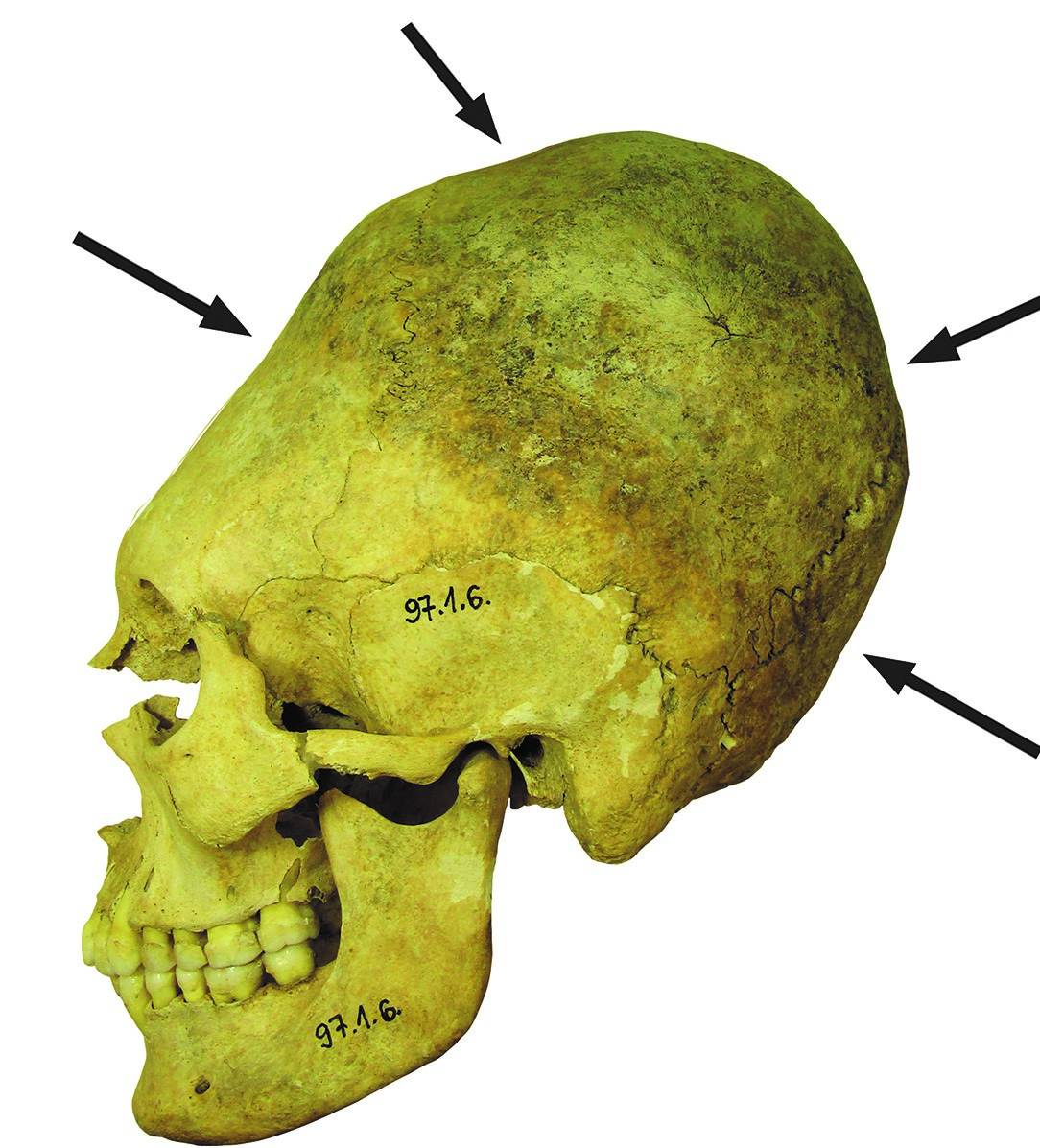 tolna 1 Mozs grave 34 skull